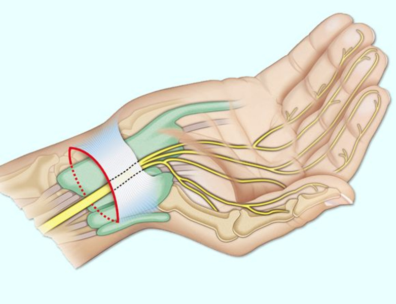 Операция карпального канала кисти. Синдром запястного (карпального) канала. Туннельный карпальный синдром руки. Карпальный (кистевой) туннельный синдром. Туннельный синдром лучезапястного сустава.